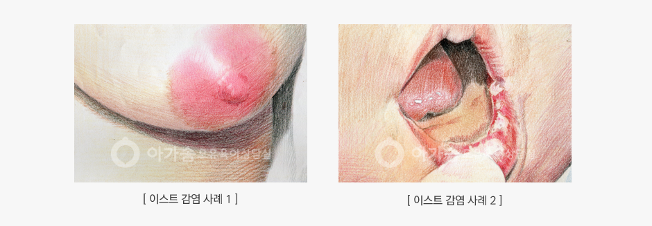 이스트감염 증상 사례 사진